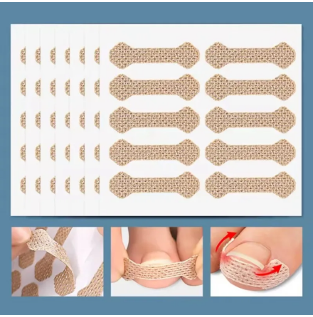Ingrown Toenail Patch � 20 st Korrigeringspl�ster